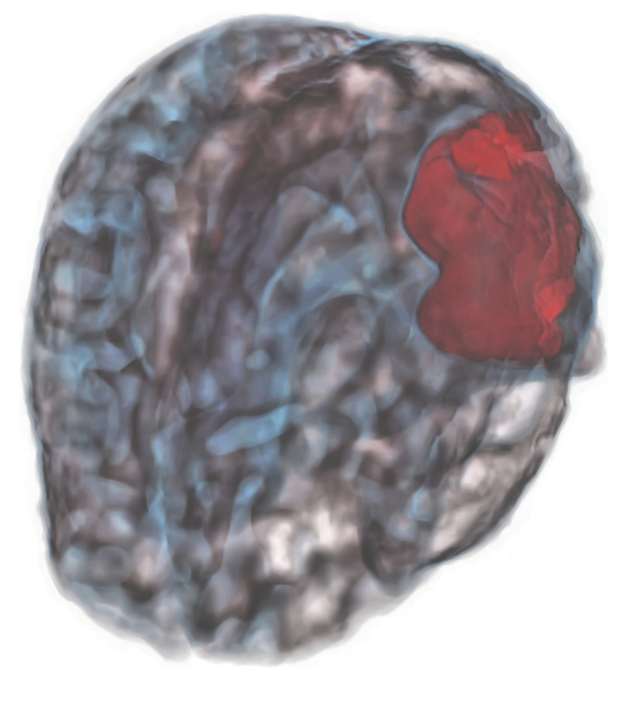 3D CT hemorrhage rendering — intracranial hemorrhage detection